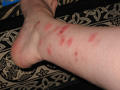 bedbugsbites.jpg bedbugsbites.jpg