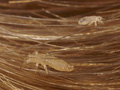 lice-in-hair-enlarged.jpg Head lice.