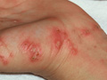scabies-bites.jpg Scabies.