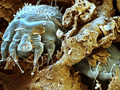 scabies.jpg Scabies.